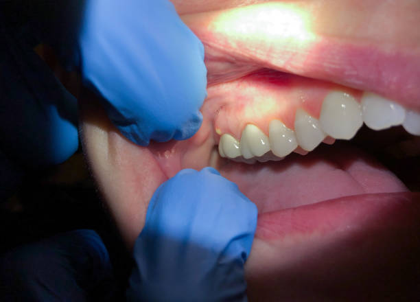 Best Cracked Tooth Emergency Dentist  in San Felipe, TX